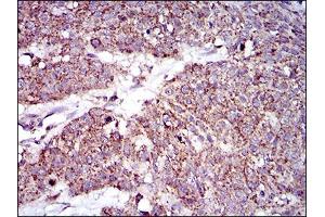 Immunohistochemical analysis of paraffin-embedded esophageal cancer tissues using MRPL42 mouse mAb with DAB staining. (MRPL42 anticorps  (AA 142-203))