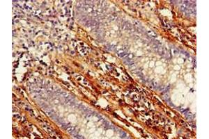 Immunohistochemistry of paraffin-embedded human colon cancer using ABIN7165903 at dilution of 1:100 (Patched 1 anticorps  (AA 1180-1411))