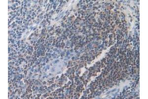 IHC-P analysis of Human Skin Cancer Tissue, with DAB staining. (DOK3 anticorps  (AA 128-385))