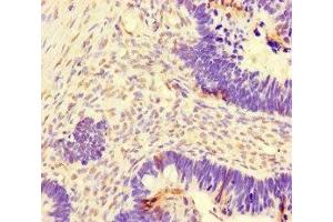 Immunohistochemistry of paraffin-embedded human ovarian cancer using ABIN7150550 at dilution of 1:100 (DNAJC3 anticorps  (AA 277-496))
