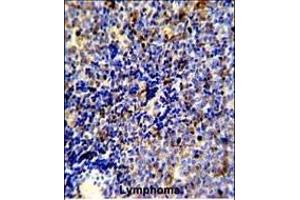Formalin-fixed and paraffin-embedded human lymphoma reacted with MERTK Antibody, which was peroxidase-conjugated to the secondary antibody, followed by DAB staining. (MERTK anticorps)