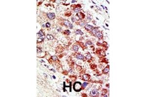 Formalin-fixed and paraffin-embedded human cancer tissue reacted with the primary antibody, which was peroxidase-conjugated to the secondary antibody, followed by AEC staining.