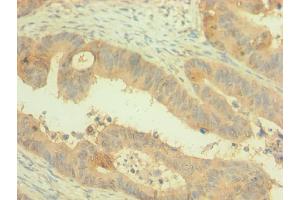 Immunohistochemistry of paraffin-embedded human colon cancer using ABIN7162499 at dilution of 1:100 (PAX4 anticorps  (AA 50-200))