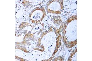 Immunohistochemical analysis of TRADD staining in human colon cancer formalin fixed paraffin embedded tissue section. (TRADD anticorps  (C-Term))