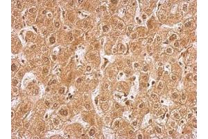 IHC-P Image AMPK gamma 2 antibody [C2C3], C-term detects PRKAG2 protein at nucleus and cytosol human on hepatoma by immunohistochemical analysis. (PRKAG2 anticorps  (C-Term))
