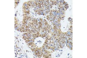 Immunohistochemistry of paraffin-embedded human colon carcinoma using KIF22 antibody  at dilution of 1:100 (40x lens).