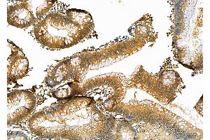 ABIN6264411 and ABIN6276954 at 1/100 staining Human colorectal cancer by IHC-P. (Peroxiredoxin 2 anticorps  (C-Term))