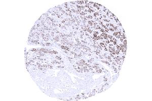 Kidney Clear cell renal cell carcinoma showing moderate to strong Melan A immunostaining of tumor cells