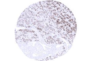 Kidney Clear cell renal cell carcinoma showing moderate to strong Melan A immunostaining of tumor cells (Recombinant MLANA anticorps)