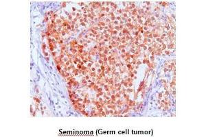 Paraffin embedded sections of Seminoma (Germ cell tumor) tissue were initrocelluloseubated with anti-human FKBP4 (1:50) for 2 hours at room temperature.