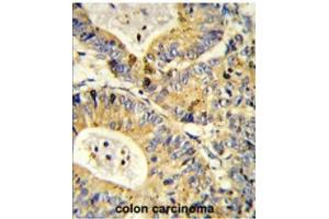 Formalin-fixed and paraffin-embedded human colon carcinoma reacted with RS18 Antibody (Center) followed which was peroxidase-conjugated to the secondary antibody, followed by DAB staining.