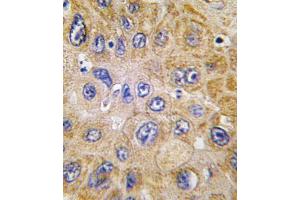 Formalin-fixed and paraffin-embedded human hepatocarcinoma tissue reacted with THY1 antibody , which was peroxidase-conjugated to the secondary antibody, followed by DAB staining. (CD90 anticorps  (N-Term))