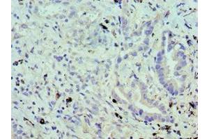 Immunohistochemistry of paraffin-embedded human lung cancer using ABIN7174459 at dilution of 1:100 (UBE2J2 anticorps  (AA 1-230))