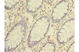 Immunohistochemistry of paraffin-embedded human colon cancer using ABIN7147425 at dilution of 1:100 (Cep76 anticorps  (AA 241-550))