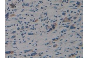 Detection of STAT2 in Human Stomach cancer Tissue using Polyclonal Antibody to Signal Transducer And Activator Of Transcription 2 (STAT2)