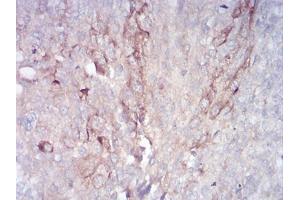 Immunohistochemical analysis of paraffin-embedded bladder cancer tissues using RAB11FIP1 mouse mAb with DAB staining. (RAB11FIP1 anticorps  (AA 130-271))