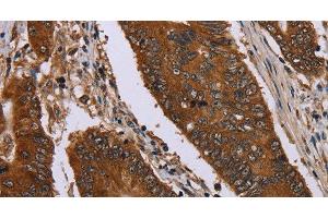 Immunohistochemistry of paraffin-embedded Human colon cancer using Catenin gamma Polyclonal Antibody at dilution of 1:40 (JUP anticorps)
