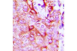 Immunohistochemical analysis of LPHN2 staining in human breast cancer formalin fixed paraffin embedded tissue section. (LPHN2 anticorps  (Center))
