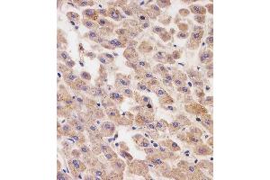 (ABIN6242760 and ABIN6577246) staining AFP in human liver tissue sections by Immunohistochemistry (IHC-P - paraformaldehyde-fixed, paraffin-embedded sections). (alpha Fetoprotein anticorps  (AA 281-609))