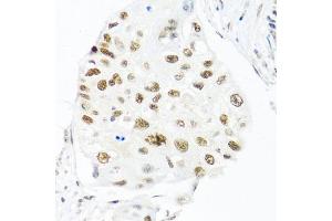 Immunohistochemistry of paraffin-embedded human lung cancer using THOC1 antibody (ABIN5974800) at dilution of 1/100 (40x lens). (THOC1 anticorps)