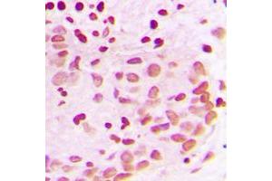 Immunohistochemical analysis of PML staining in human breast cancer formalin fixed paraffin embedded tissue section.