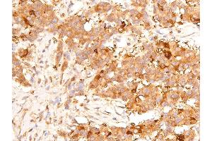 ABIN6267289 at 1/100 staining human liver cancer tissue sections by IHC-P.