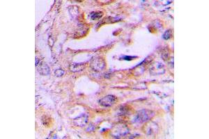 Immunohistochemical analysis of NDRG2 staining in human lung cancer formalin fixed paraffin embedded tissue section. (NDRG2 anticorps  (Center))