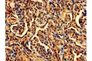 IHC image of ABIN7164696 diluted at 1:200 and staining in paraffin-embedded human lung cancer performed on a Leica BondTM system. (PDCD6 anticorps  (AA 1-191))