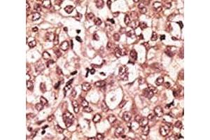 IHC analysis of FFPE human hepatocarcinoma tissue stained with the TLR6 antibody