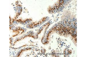 Immunohistochemistry of Human gastric cancer using TRPC6 Polyclonal Antibody at dilution of 1:40 (TRPC6 anticorps)