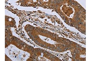 The image on the left is immunohistochemistry of paraffin-embedded Human colon cancer tissue using ABIN7191233(KLRF1 Antibody) at dilution 1/30, on the right is treated with synthetic peptide.