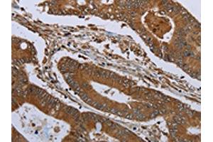 The image on the left is immunohistochemistry of paraffin-embedded Human colon cancer tissue using ABIN7191233(KLRF1 Antibody) at dilution 1/30, on the right is treated with synthetic peptide. (KLRF1 anticorps)
