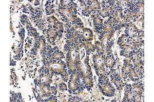 C12orf65 Antibody at 1/100 staining human colorectal cancer by IHC-P.