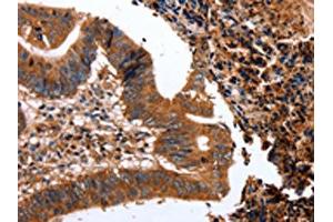 The image on the left is immunohistochemistry of paraffin-embedded Human colon cancer tissue using ABIN7128966(CLEC4A Antibody) at dilution 1/15, on the right is treated with fusion protein. (CLEC4A anticorps)