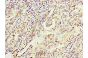 Immunohistochemistry of paraffin-embedded human lung cancer using ABIN7142261 at dilution of 1:100 (MRPS22 anticorps  (AA 1-360))
