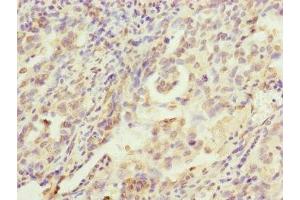 Immunohistochemistry of paraffin-embedded human lung cancer using ABIN7142261 at dilution of 1:100