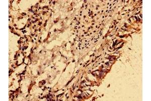 Immunohistochemistry analysis of human lung cancer using ABIN7162040 at dilution of 1:100