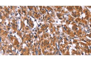 Immunohistochemistry of paraffin-embedded Human thyroid cancer tissue using TDP2 Polyclonal Antibody at dilution 1:40 (TDP2 anticorps)