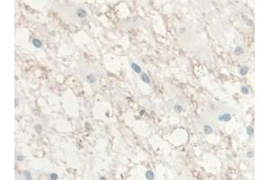 IHC-P analysis of Human Glioma Tissue, with DAB staining. (IL-10 anticorps  (AA 1-178))