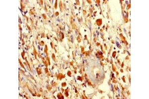 Immunohistochemistry of paraffin-embedded human melanoma using ABIN7165358 at dilution of 1:100 (FAM114A2 anticorps  (AA 1-505))
