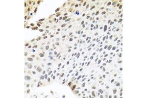 Immunohistochemistry of paraffin-embedded human lung cancer using SKIV2L2 antibody. (MTR4 anticorps  (AA 1-304))