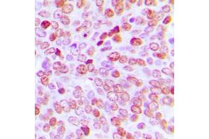 Immunohistochemical analysis of TBP staining in human prostate cancer formalin fixed paraffin embedded tissue section.