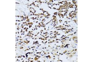 Immunohistochemistry of paraffin-embedded human lung cancer using PIKFYVE antibody (ABIN5974035) at dilution of 1/100 (40x lens). (PIKFYVE anticorps)