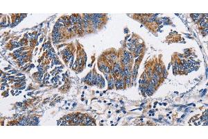 Immunohistochemistry of paraffin-embedded Human colon cancer tissue using NPPA Polyclonal Antibody at dilution 1:60 (NPPA anticorps)