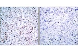Immunohistochemistry analysis of paraffin-embedded human breast carcinoma, using c-Jun (Phospho-Ser63) Antibody.