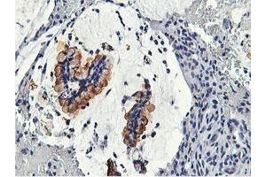 Immunohistochemical staining of paraffin-embedded Adenocarcinoma of Human colon tissue using anti-CAPN9 mouse monoclonal antibody. (Calpain 9 anticorps)