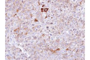 IHC-P Image Immunohistochemical analysis of paraffin-embedded CL1-0 xenograft , using Synaptophysin, antibody at 1:100 dilution. (Synaptophysin anticorps  (C-Term))