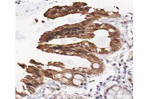 ABIN6267259 at 1/200 staining human colon carcinoma sections by IHC-P. (EGFR anticorps  (pThr693))