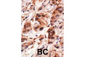 Formalin-fixed and paraffin-embedded human cancer tissue reacted with the HSPA5 polyclonal antibody  , which was peroxidase-conjugated to the secondary antibody, followed by DAB staining.