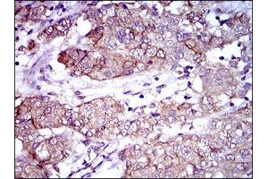 Immunohistochemical analysis of paraffin-embedded bladder cancer tissues using ALCAM mouse mAb with DAB staining.